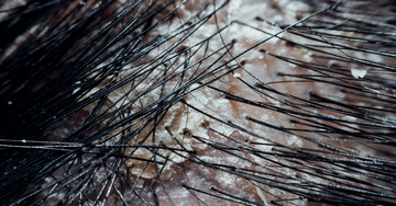 Seborrheic Dermatitis