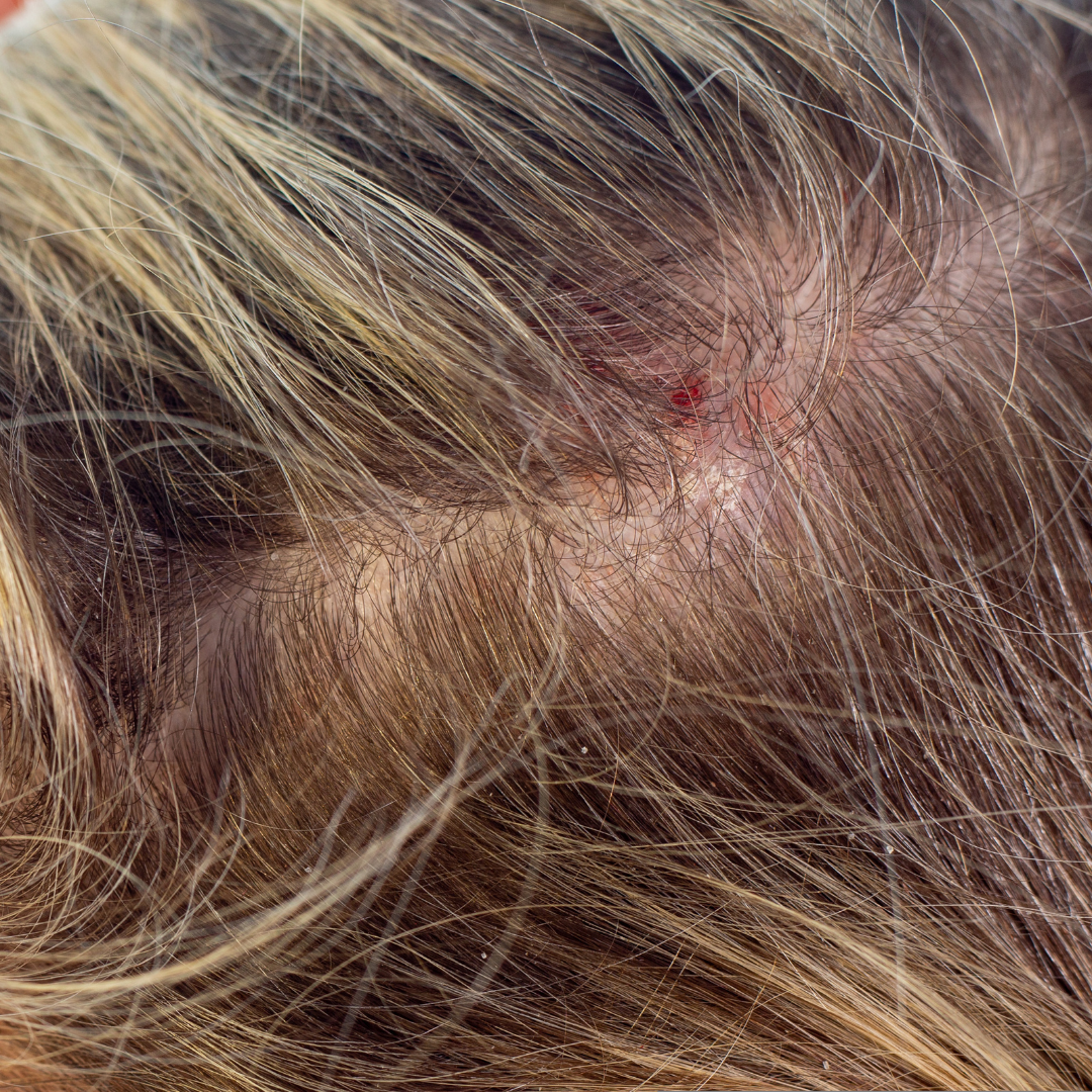 Trichology Consultation