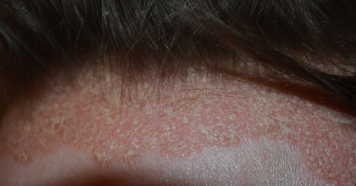 Eczema on the Scalp