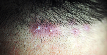 Acne Vulgaris of the Scalp
