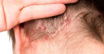 Psoriasis of the scalp