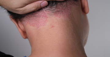 Do I have Scalp Psoriasis or Dermatitis?