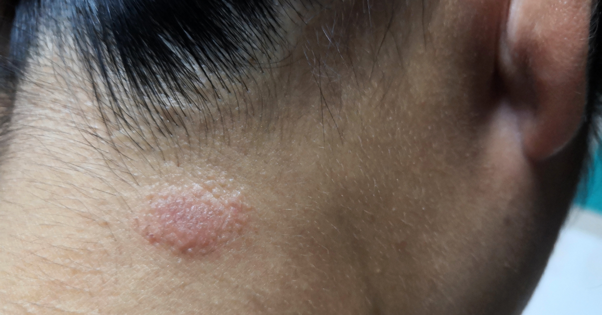Tinea Capitis