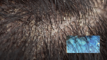 Seborrheic Dermatitis
