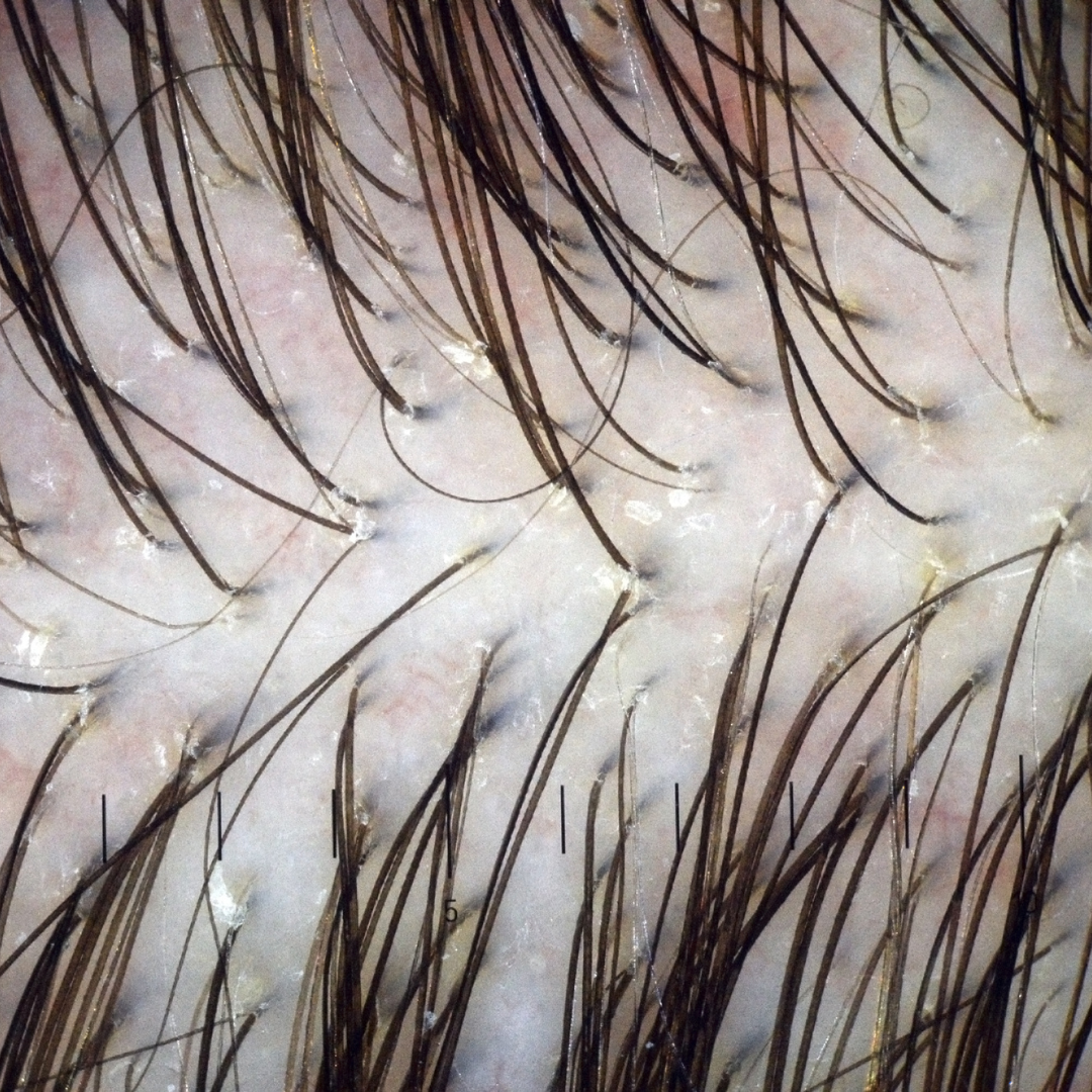 Trichology Consultation